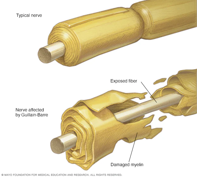 Guillain-Barré Syndrome (GBS): Symptoms, Recovery and the Role of Physical Therapy